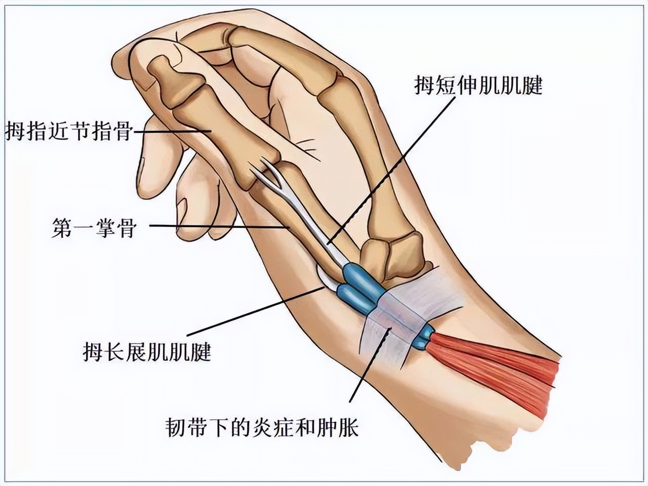 肌腱炎是什么症状(腱鞘炎有哪些常见症状和预防的方法 百百科