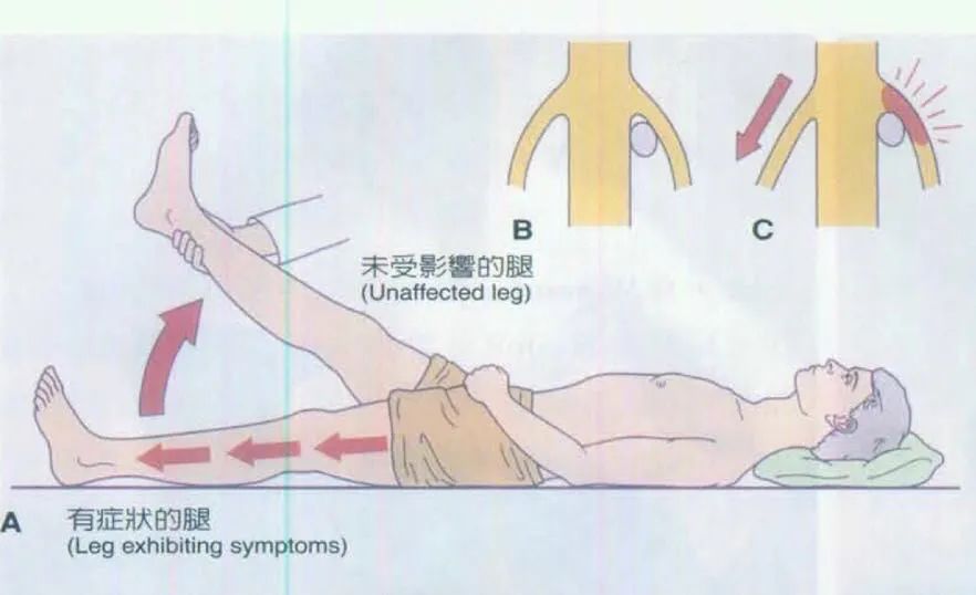 80%的腰椎间盘突出症，靠这4种方法能缓解