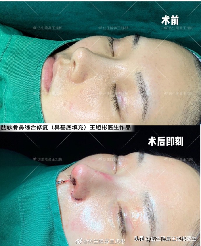 广州隆鼻科普：王旭彬鼻整形修复案例分享