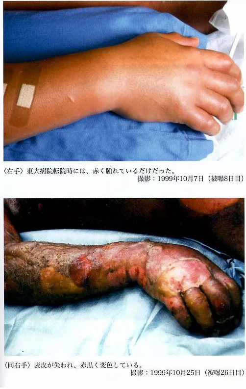 在遭受2万倍辐射之后,他亲眼看着自己的身体腐烂却无能为力