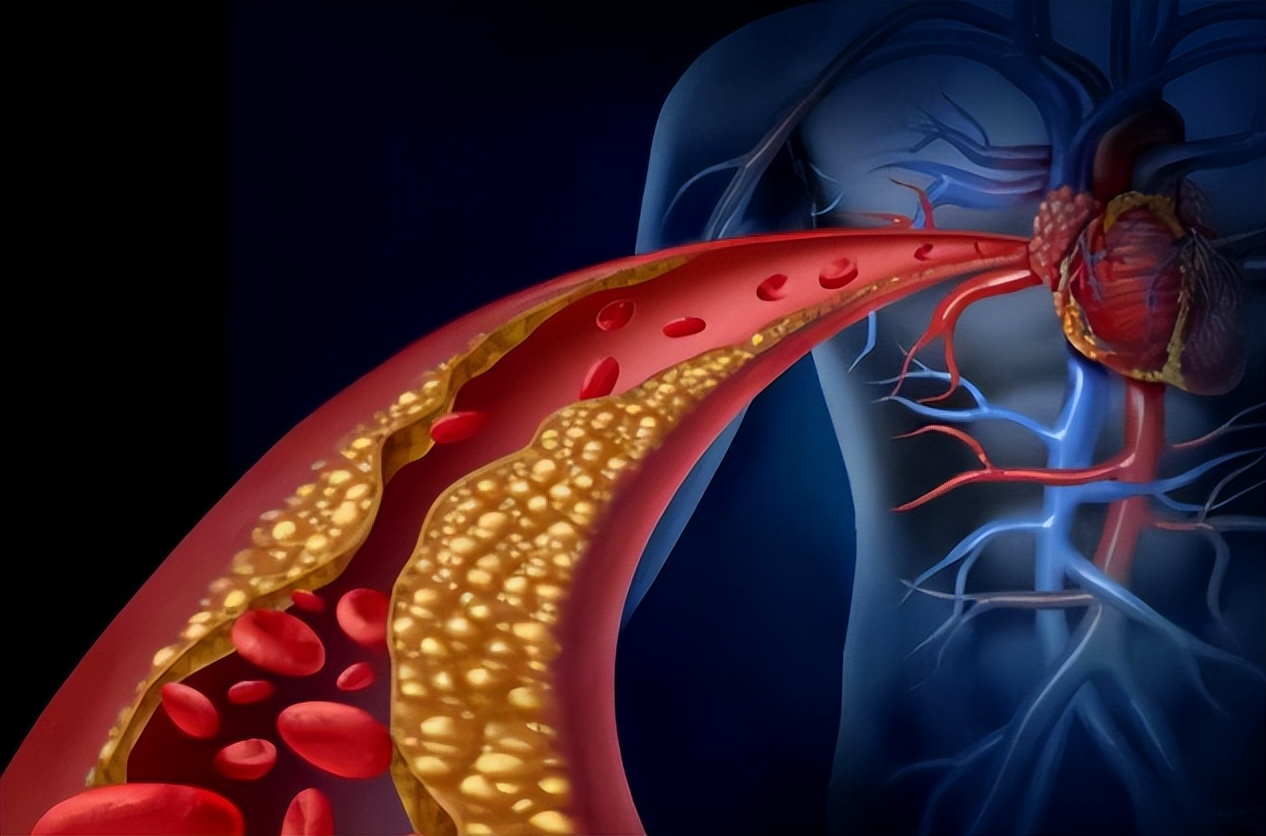 多走路有助降血脂？医生：4种食物的降脂效果，可能比走路还好