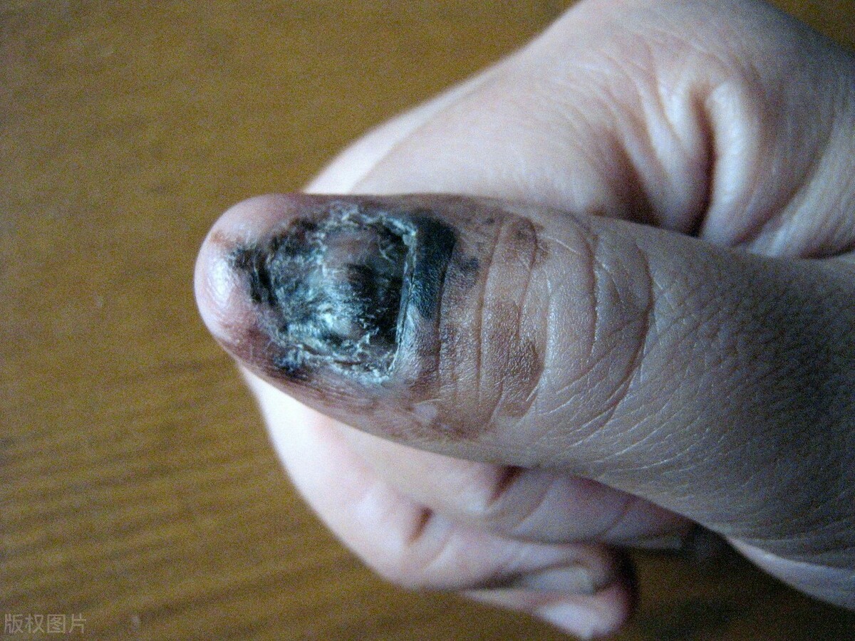 指甲黑色素瘤图片图片