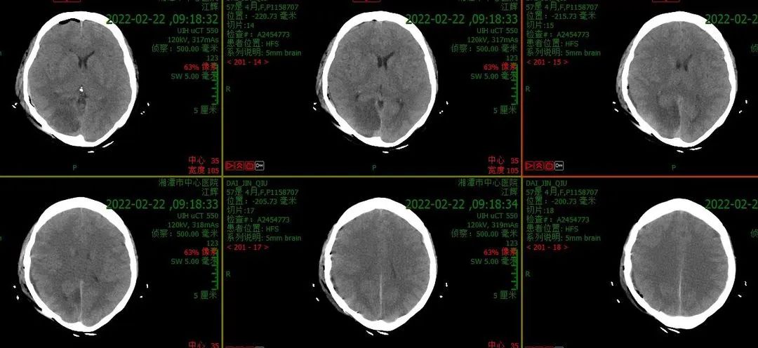 新闻报道中被车撞了不肯就医的重型脑外伤患者，今天出院了