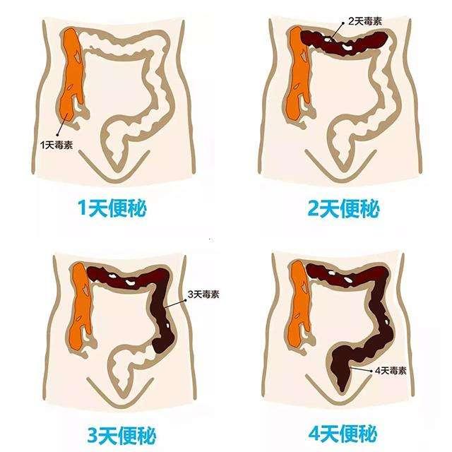 大便“前头干硬，后边软粘”是咋回事？大便异常，是肠癌的前兆吗