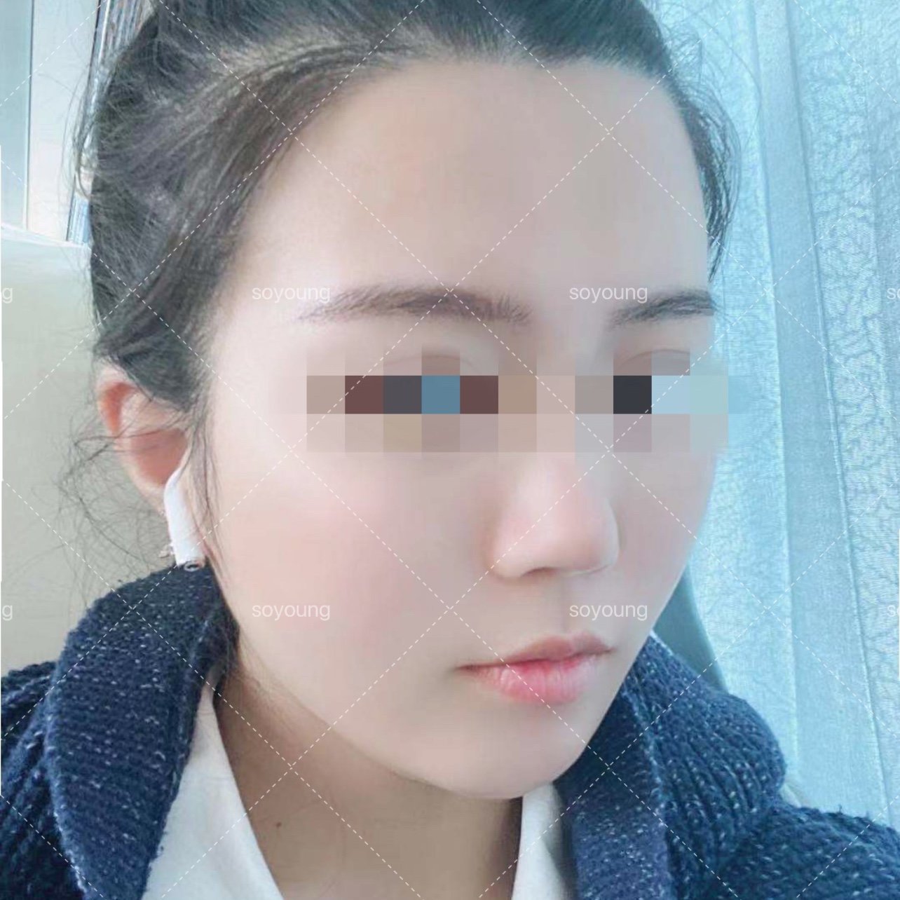 30岁的张女士面部吸脂，女儿读书回家以为我换了一张脸