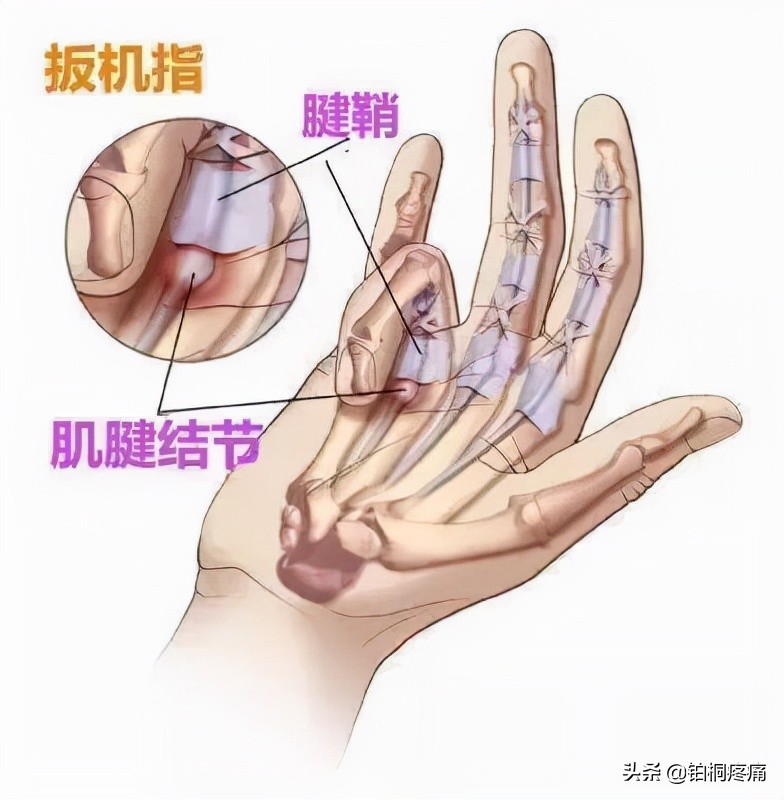 疼爱博士｜手指僵硬、不能弯曲，伸直——原来是腱鞘炎惹的祸