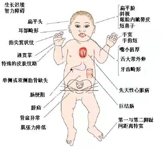 唐氏儿手指内弯图片图片