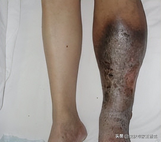 老人腿上的“小蚯蚓”，嚴重的候危及生命，可很多人卻不管