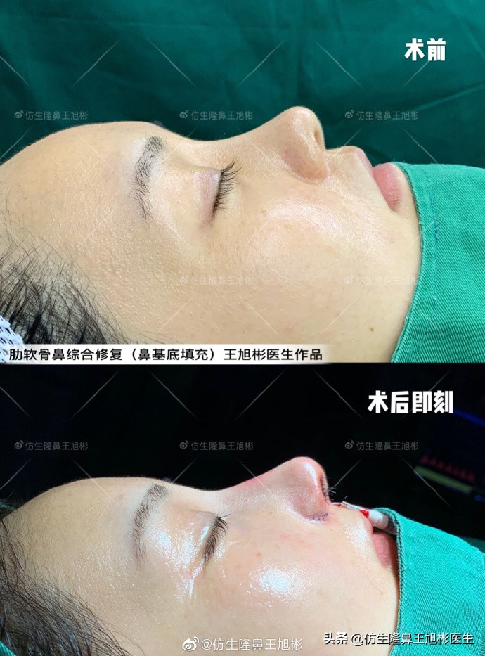广州正规整形医院排名及隆鼻手术科普指南