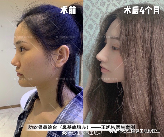 广州隆鼻科普：王旭彬鼻整形修复案例分享