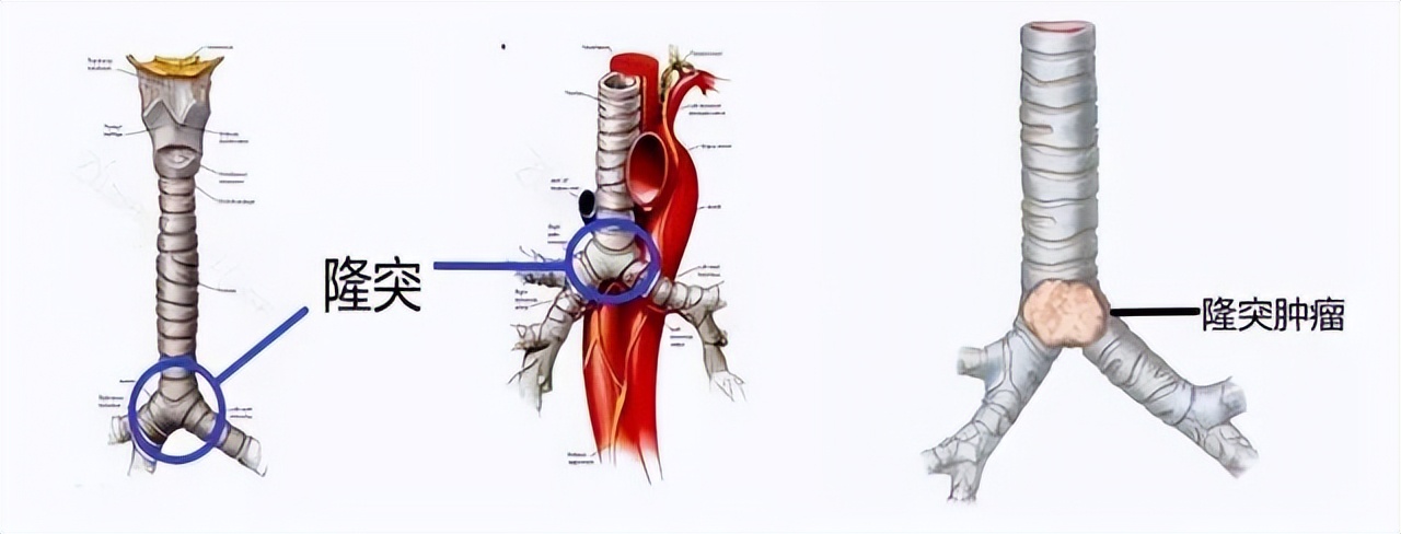 气管隆突成形术图片