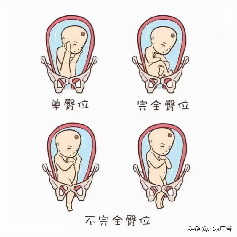 如何判断臀位胎儿是否已转为头位