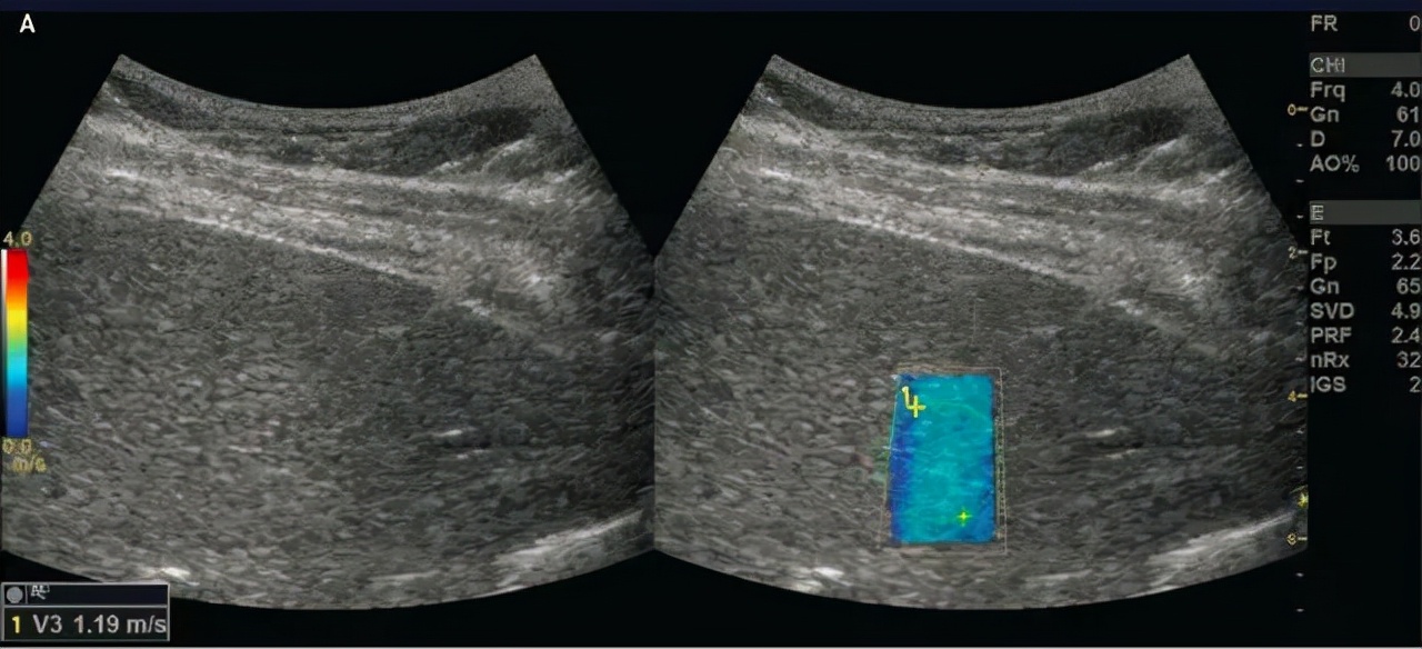 vns86com威尼斯城超声新神探——肝脏纤维化超声弹性成像