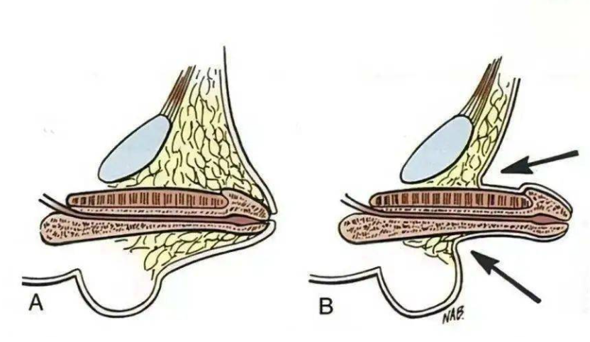 男性割包皮到底好不好?没搞懂3个问题,你可能"白挨一刀"