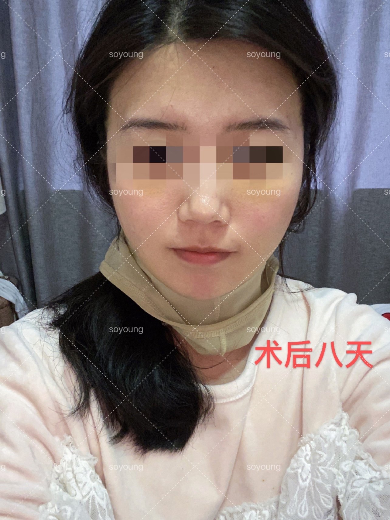 30岁的张女士面部吸脂，女儿读书回家以为我换了一张脸