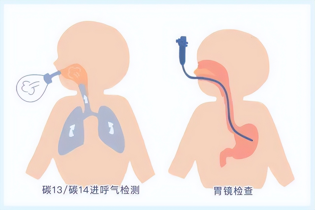 认识"吹气"的正确姿势,呼气试验测幽门螺杆菌,准确率高达97%