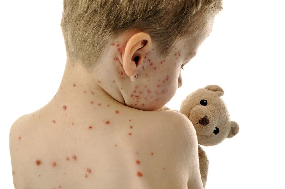 幼儿出水痘的症状图片图片