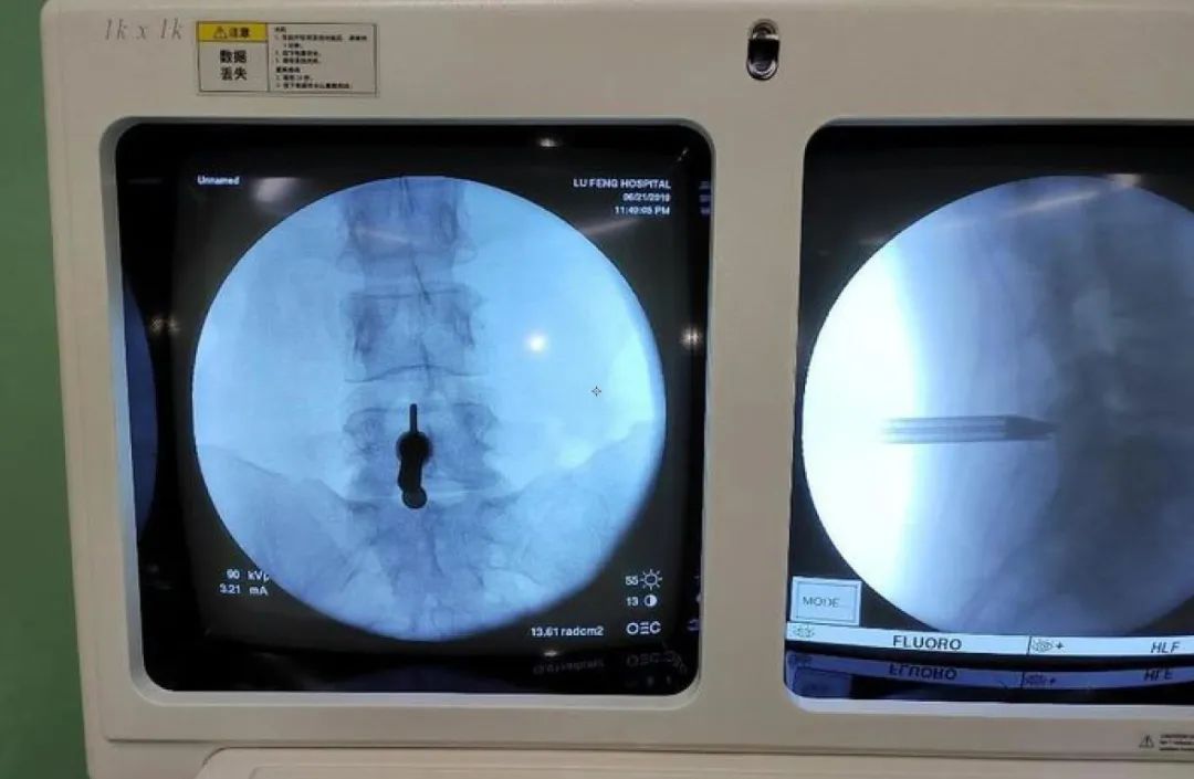 禄丰市人民医院成功完成市域内首例椎间孔镜下椎间盘摘除术