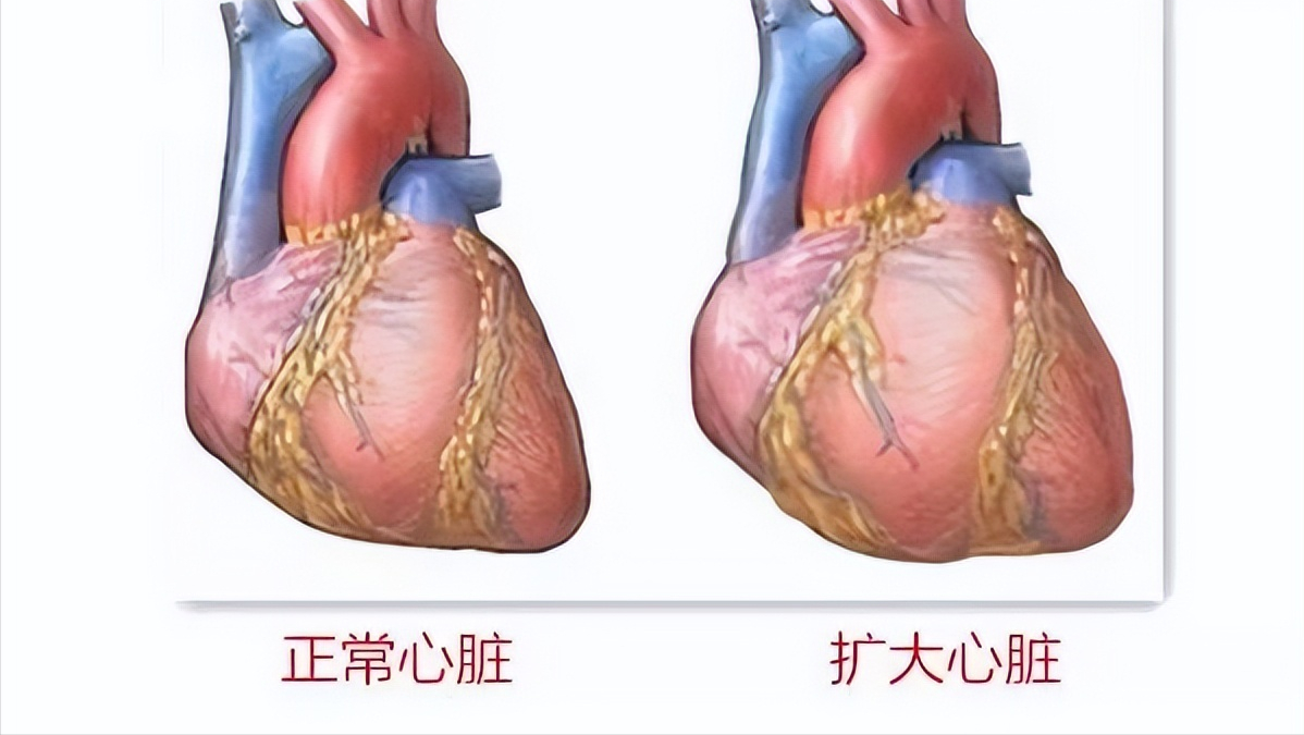 孩子确诊先心病——左冠状动脉异常起源于肺动脉，还有得治吗？