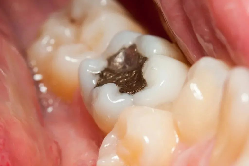 为什么蛀牙了要及时补牙？市面上的补牙材料该怎么挑？