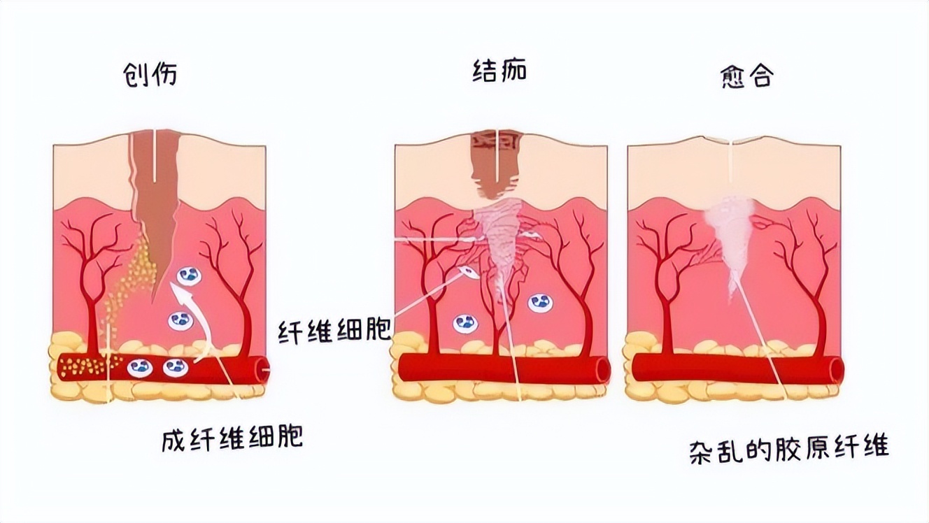 担心疤痕增生！您知道该怎么用祛疤药吗？