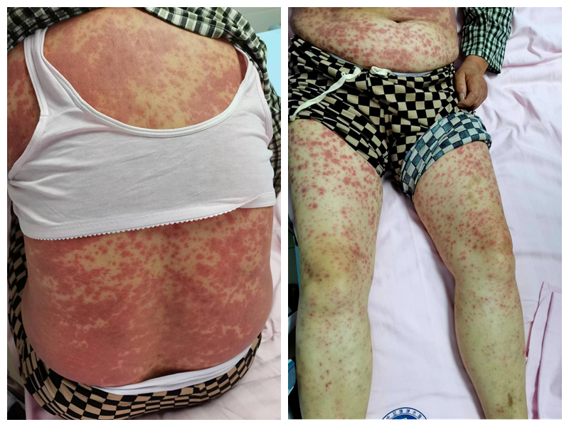 生命相托 用心守护—郫都区中医院皮肤科全力抢救危重药物过敏患者