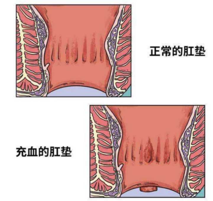 不同的痔疮都是怎么治疗的呢？