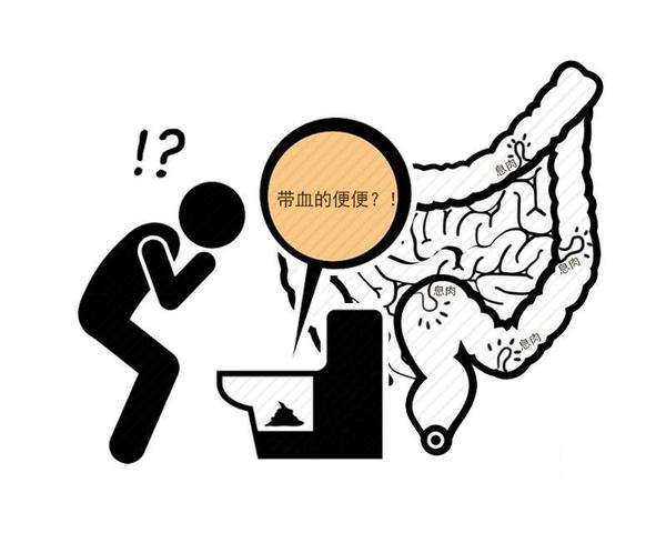 息肉是否会发生癌变？医生：这3类息肉癌变的几率大，需重视