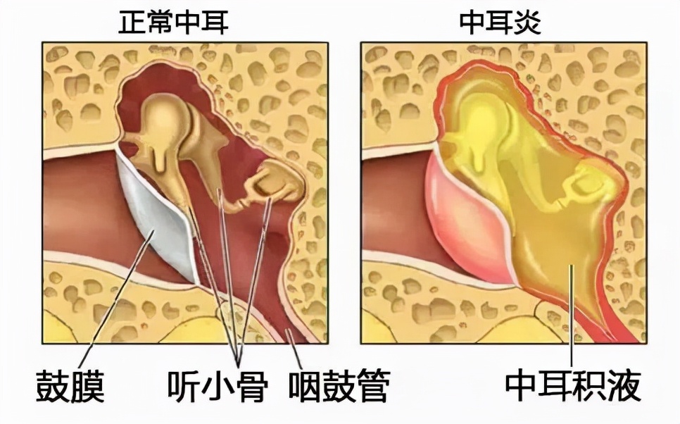 「爱耳日」市中心医院耳科来答疑释惑①恼人的分泌性中耳炎