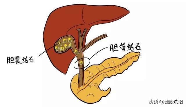 把健康帶回家 | 得了膽囊結石怎么办？