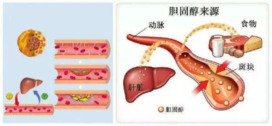 不吃肉，饮食清淡，为什么体检血脂高？这6种情况可引起高血脂
