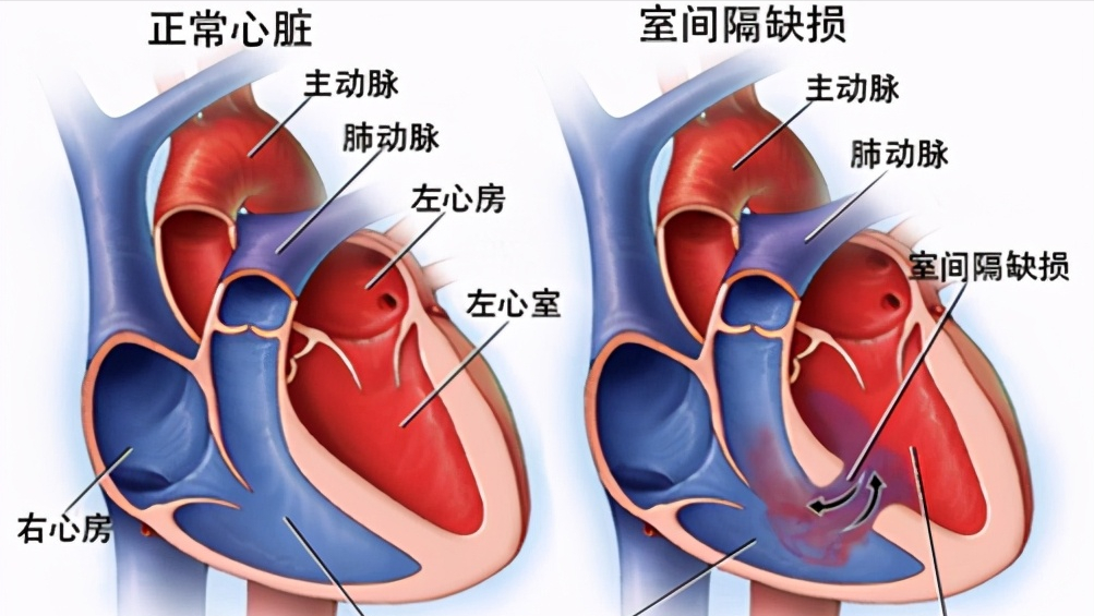 家长请重视：有4类心脏病专挑孩子“下手”，应该多留个心眼