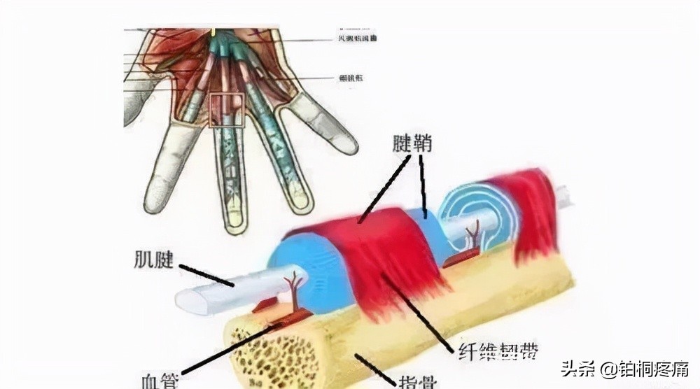 疼爱博士｜手指僵硬、不能弯曲，伸直——原来是腱鞘炎惹的祸