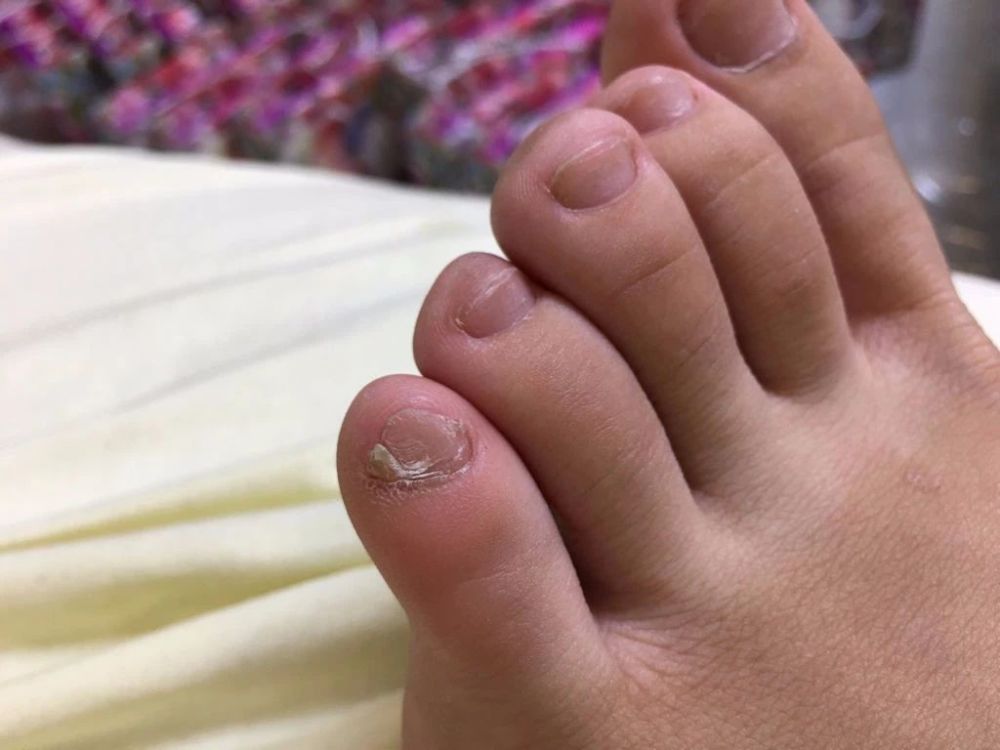 小脚趾指甲长成两瓣、三瓣的人，究竟是什么来历？有科学说法吗