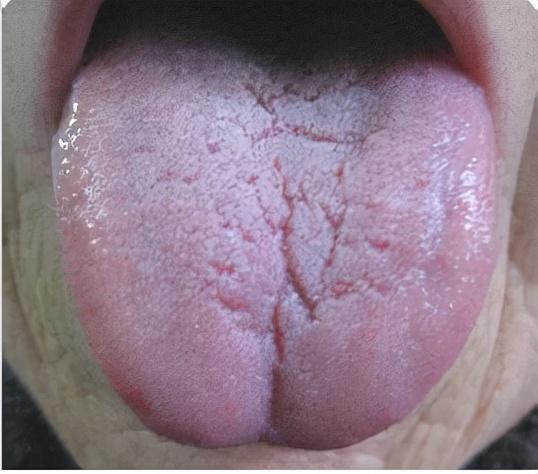 舌头有裂纹是因为什么原因引起的该如何调理