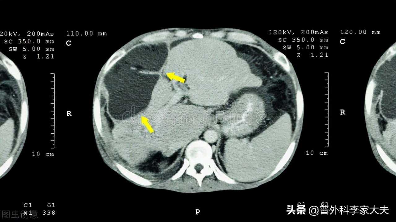 6cm大小的肝癌，该如何治疗？