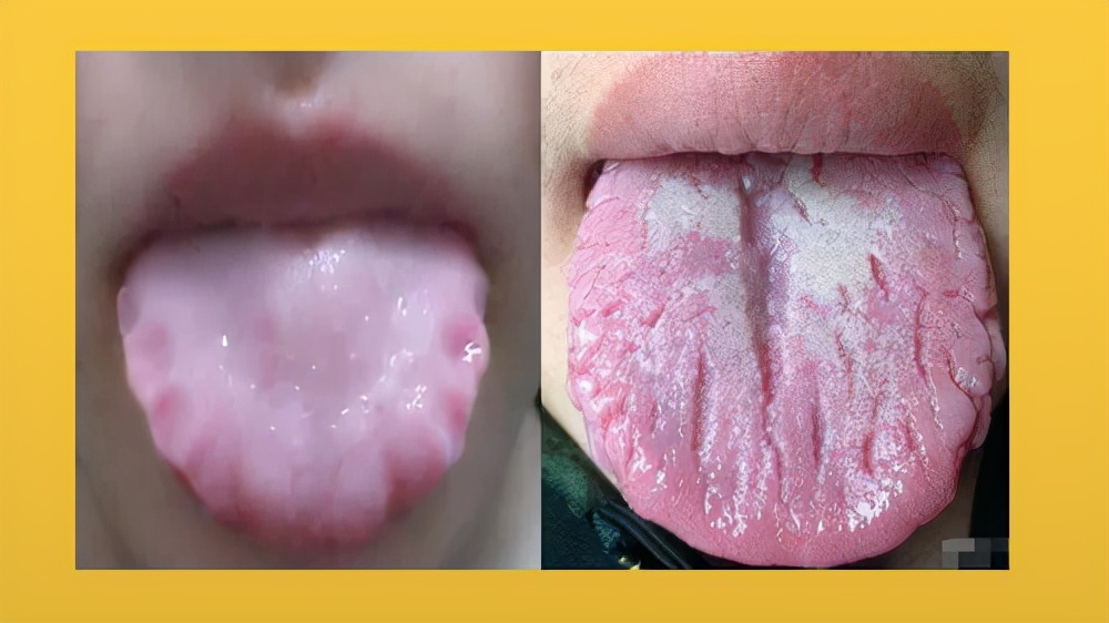 3种齿痕5种裂纹,你是哪一种?