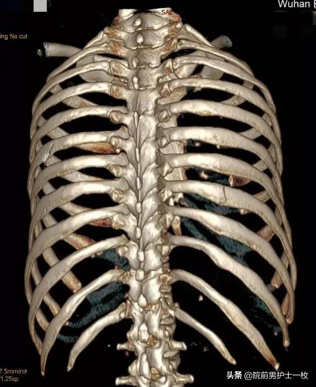 多发肋骨骨折的处置措施