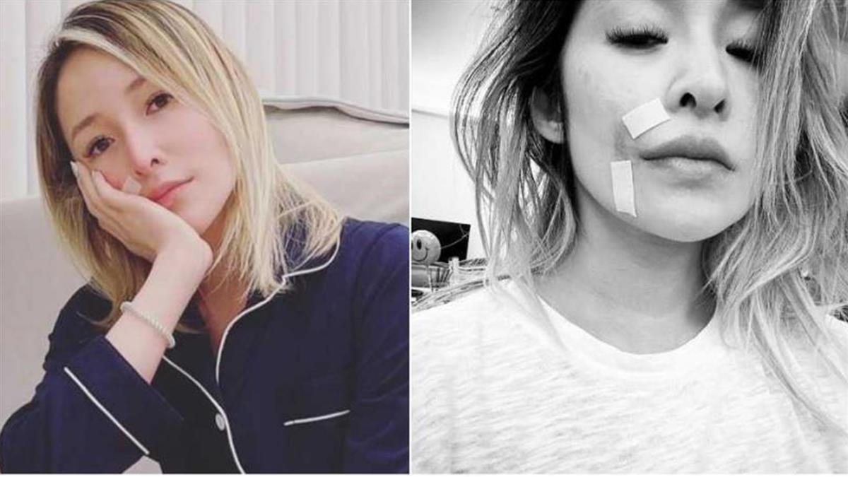 萧亚轩宣告正式复出,脸上被爱犬咬伤的伤疤清晰可见