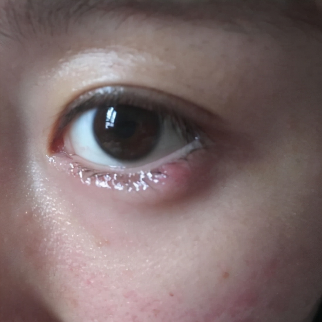 金霉素眼膏多少钱几块钱一支的红霉素眼膏