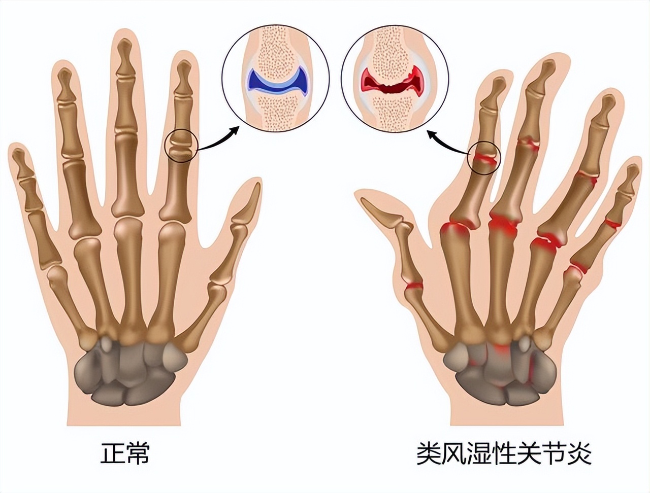 老年人手指僵硬,關節痛,正常嗎?該如何緩解?一文詳細告訴你