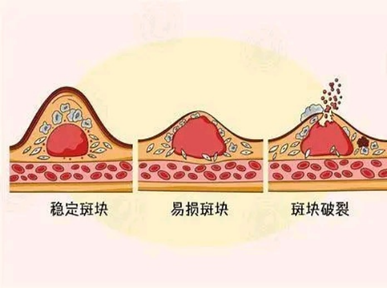 中年男子患颈动脉斑块，吃了5年他汀，看看现在的检查化验结果