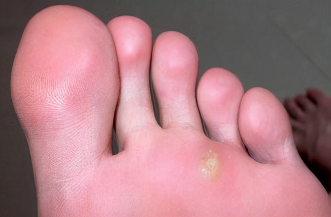 分辨跖疣,鸡眼和老茧——跖疣的治疗方法