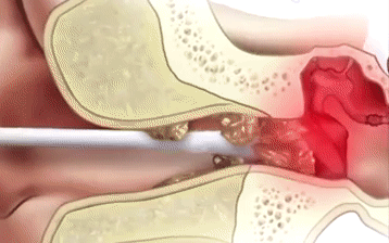 耳朵里面痒，却啥也掏不出来？或是4种病的表现，别光顾着抠了