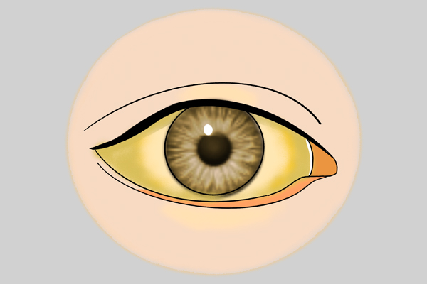 检查出3种肝病，其实不用着急治疗，多数人不知，在自己吓自己