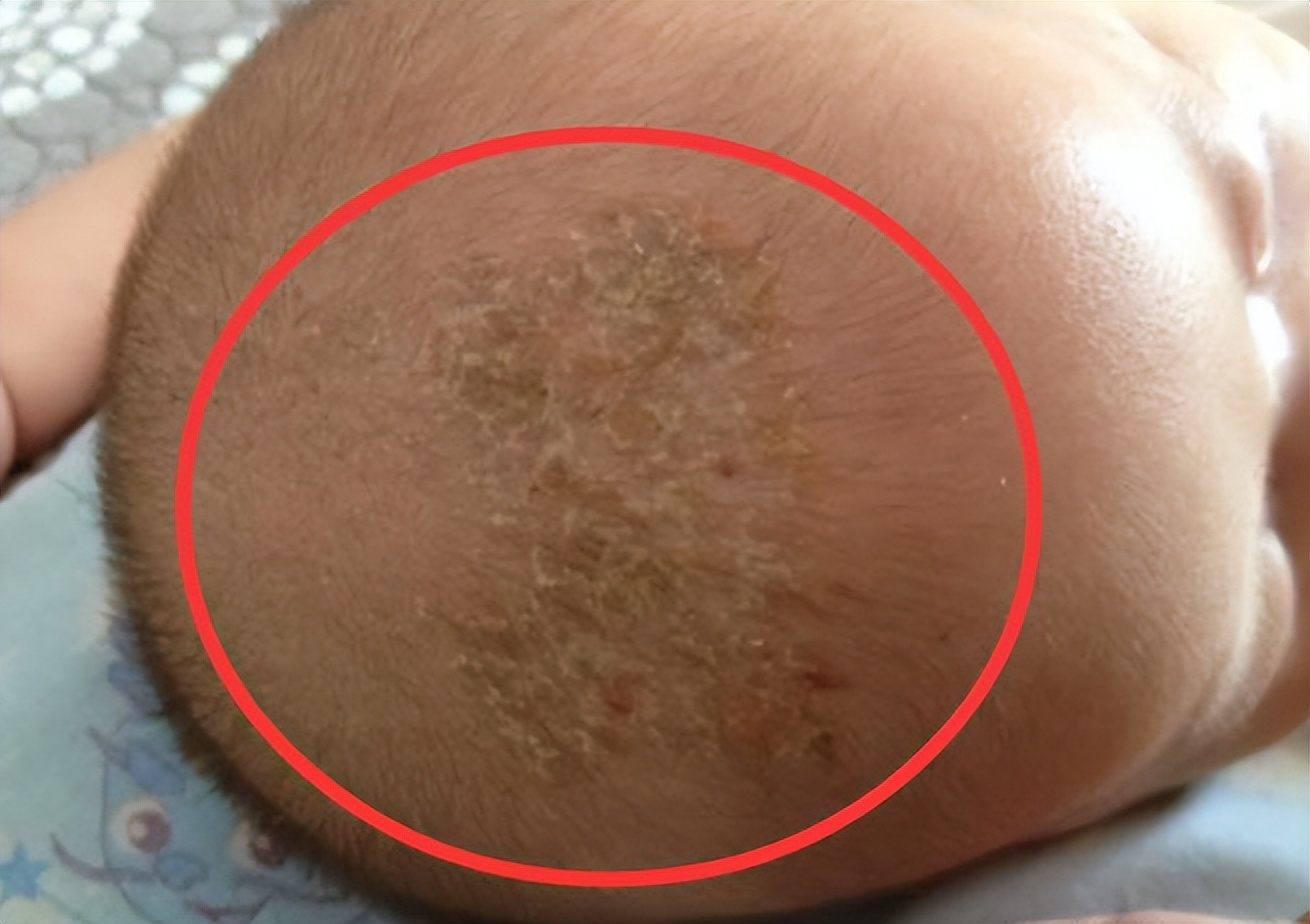 有一种"强迫症"是给宝宝抠乳痂,家长看上去爱干净,其实很坑娃