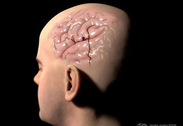 婴儿脑部发育不良症状(7岁孩童因脑血管畸形) - 乐宝宝贝