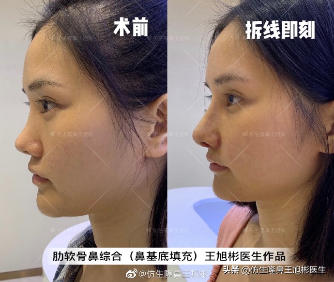广州隆鼻科普：王旭彬鼻整形修复案例分享