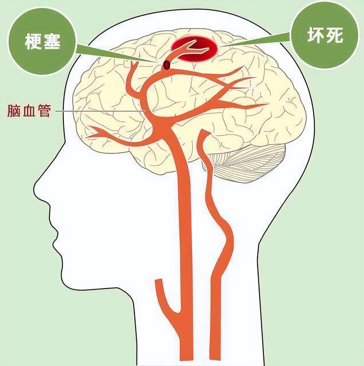脑梗发生前7-30天，身体或会发出“警告信号”，请别视而不见