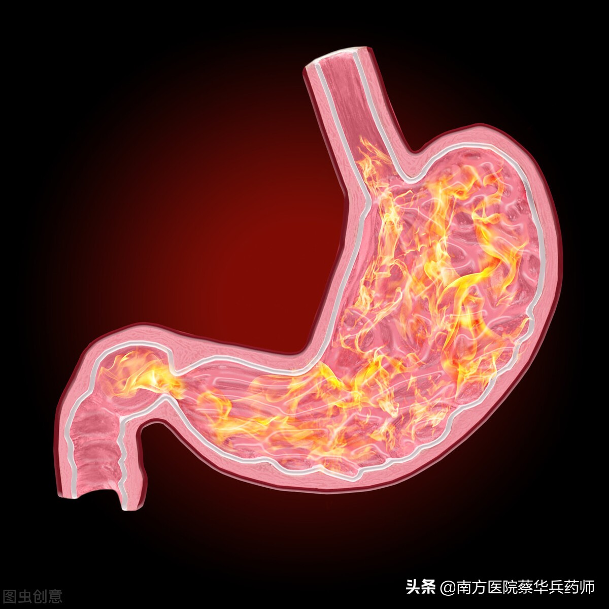 治胃病方子（反酸燒心篇）